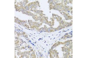 Immunohistochemistry of paraffin-embedded human liver cancer using TIMM10B antibody at dilution of 1:100 (x40 lens). (TIMM10B Antikörper)