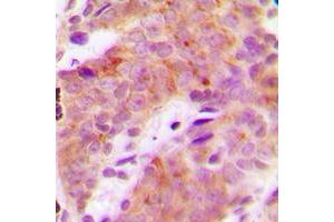 Immunohistochemical analysis of S6K1 (pT421) staining in human breast cancer formalin fixed paraffin embedded tissue section.