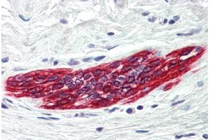 Human Breast (formalin-fixed, paraffin-embedded) stained with DAPK2 antibody ABIN214481 at 5 ug/ml followed by biotinylated goat anti-rabbit IgG secondary antibody ABIN481713, alkaline phosphatase-streptavidin and chromogen. (DAPK2 Antikörper  (C-Term))