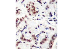 Immunohistochemistry (IHC) image for anti-Signal Transducer and Activator of Transcription 5A (STAT5A) (pTyr694) antibody (ABIN3019614) (STAT5A Antikörper  (pTyr694))