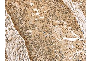 The image on the left is immunohistochemistry of paraffin-embedded Human esophagus cancer tissue using ABIN7131203(STAG2 Antibody) at dilution 1/35, on the right is treated with fusion protein. (STAG2 Antikörper)