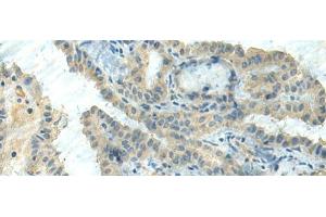 Immunohistochemistry of paraffin-embedded Human thyroid cancer tissue using CTDP1 Polyclonal Antibody at dilution of 1:55(x200) (CTDP1 Antikörper)