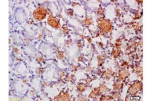 Formalin-fixed and paraffin embedded human gastric carcinoma labeled Anti-MAdCAM-1 Polyclonal Antibody, Unconjugated at 1:200, followed by conjugation to the secondary antibody and DAB staining (MADCAM1 Antikörper  (AA 151-250))