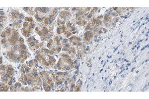ABIN6269382 at 1/100 staining Human liver cancer tissue by IHC-P. (B-Cell Linker Antikörper  (N-Term))