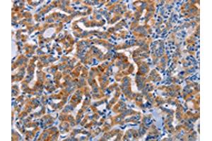 The image on the left is immunohistochemistry of paraffin-embedded Human thyroid cancer tissue using ABIN7128355(ALG12 Antibody) at dilution 1/20, on the right is treated with fusion protein. (ALG12 Antikörper)