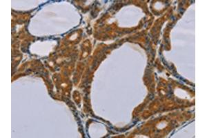 The image on the left is immunohistochemistry of paraffin-embedded Human thyroid cancer tissue using ABIN7130584(PEF1 Antibody) at dilution 1/20, on the right is treated with fusion protein. (PEF1 Antikörper)