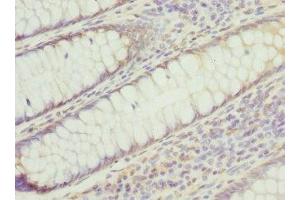 Immunohistochemistry of paraffin-embedded human colon cancer using ABIN7142221 at dilution of 1:100 (PSMD8 Antikörper  (Regulatory Subunit 8))