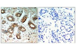 Immunohistochemical analysis of paraffin-embedded human breast carcinoma tissue using 14-3-3z(Phospho-Ser58) Antibody(left) or the same antibody preincubated with blocking peptide(right). (14-3-3 zeta Antikörper  (pSer58))