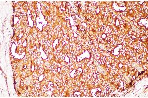 Immunohistochemistry of paraffin-embedded Human prostate cancer using FOLH1 Polycloanl Antibody at dilution of 1:200 (PSMA Antikörper)