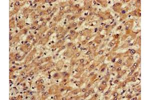 Immunohistochemistry of paraffin-embedded human liver cancer using ABIN7150673 at dilution of 1:100 (TGDS Antikörper  (AA 143-305))