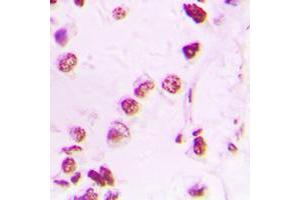 Immunohistochemical analysis of p300 staining in human lung cancer formalin fixed paraffin embedded tissue section. (p300 Antikörper  (N-Term))