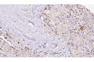 ABIN6273309 at 1/100 staining Human thyroid cancer tissue by IHC-P. (RIC8B Antikörper  (C-Term))