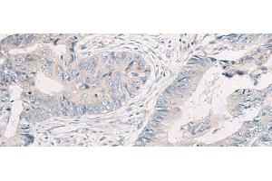 Immunohistochemistry of paraffin-embedded Human colorectal cancer tissue using WNK4 Polyclonal Antibody at dilution of 1:45(x200) (WNK4 Antikörper)