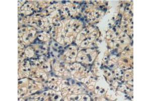 IHC-P analysis of kidney cancer tissue, with DAB staining. (IL12RB2 Antikörper  (AA 145-275))