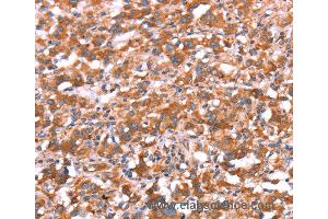 Immunohistochemistry of Human gastric cancer using GAS8 Polyclonal Antibody at dilution of 1:30 (GAS8 Antikörper)
