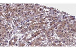 ABIN6277402 at 1/100 staining Human liver cancer tissue by IHC-P. (SLC16A4 Antikörper  (Internal Region))