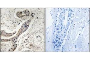 Immunohistochemistry analysis of paraffin-embedded human breast carcinoma, using BCL-XL (Phospho-Thr115) Antibody. (BCL2L1 Antikörper  (pThr115))