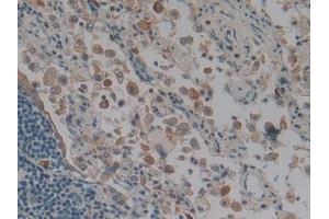 IHC-P analysis of Human Lung cancer Tissue, with DAB staining. (Keratin 3 Antikörper  (AA 198-514))