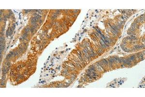 Immunohistochemistry of paraffin-embedded Human colon cancer using SH-PTP1 Polyclonal Antibody at dilution of 1:35 (SHP1 Antikörper)