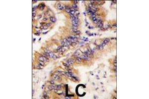 Formalin-fixed and paraffin-embedded human lung carcinoma tissue reacted with TRAPPC4 antibody , which was peroxidase-conjugated to the secondary antibody, followed by DAB staining. (TRAPPC4 Antikörper  (N-Term))