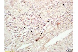 Formalin-fixed and paraffin embedded human lung carcinoma labeled with Rabbit Anti KIF11/Eg5/TRIP5 Polyclonal Antibody, Unconjugated (ABIN872373) at 1:200 followed by conjugation to the secondary antibody and DAB staining (K11 (AA 351-450) Antikörper)