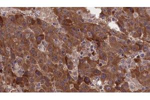 ABIN6277378 at 1/100 staining Human liver cancer tissue by IHC-P. (GRM8 Antikörper  (C-Term))
