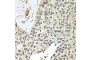 Immunohistochemistry of paraffin-embedded human lung cancer using SNRPD2 antibody at dilution of 1:100 (x40 lens). (SNRPD2 Antikörper)