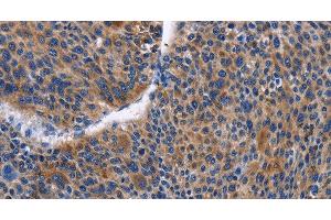 Immunohistochemistry of paraffin-embedded Human liver cancer tissue using IGSF10 Polyclonal Antibody at dilution 1:50 (IGSF10 Antikörper)
