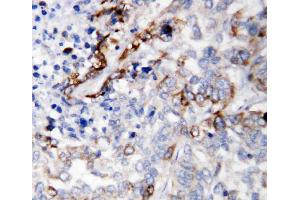 Anti-LAMC2 antibody, IHC(P): Human Lung Cancer Tissue (LAMC2 Antikörper  (C-Term))