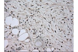 Immunohistochemical staining of paraffin-embedded Carcinoma of kidney tissue using anti-SATB1mouse monoclonal antibody. (SATB1 Antikörper)