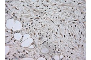 Immunohistochemical staining of paraffin-embedded Carcinoma of kidney tissue using anti-SATB1mouse monoclonal antibody.