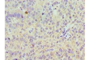 Immunohistochemistry of paraffin-embedded human liver cancer using ABIN7158607 at dilution of 1:100 (LYVE1 Antikörper  (AA 20-238))