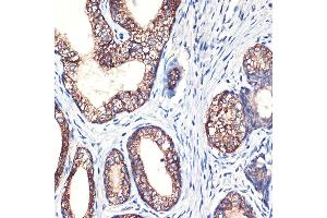Immunohistochemistry of paraffin-embedded human prostate cancer using Arginase 2 (Arginase 2 ) Rabbit mAb (ABIN7265661) at dilution of 1:100 (40x lens). (ARG2 Antikörper  (Arg2))