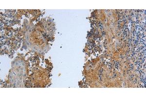 Immunohistochemistry of paraffin-embedded Human tonsil tissue using DLG4 Polyclonal Antibody at dilution 1:30 (DLG4 Antikörper)