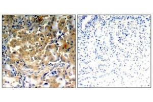Immunohistochemical analysis of paraffin-embedded human lung carcinoma tissue using PKCζ (Phospho-Thr410) antibody. (PKC zeta Antikörper  (pThr410))