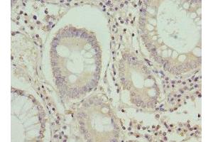 Immunohistochemistry of paraffin-embedded human colon cancer using ABIN7154629 at dilution of 1:100 (K-RAS Antikörper  (AA 2-168))