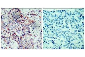 Immunohistochemical analysis of paraffin-embedded human breast carcinoma tissue using SEK1/MKK4(Phospho-Ser80) Antibody(left) or the same antibody preincubated with blocking peptide(right). (MAP2K4 Antikörper  (pSer80))