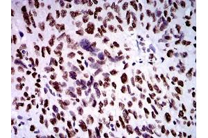 Immunohistochemical analysis of paraffin-embedded ovarian cancer tissues using ZFP91 mouse mAb with DAB staining. (ZFP91 Antikörper  (AA 162-304))