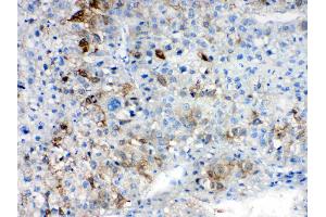 IHC analysis of AKR1B10 using anti- AKR1B10 antibody . (AKR1B10 Antikörper  (C-Term))