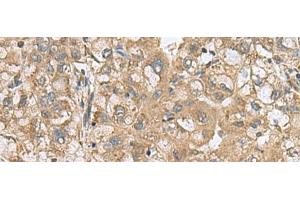 Immunohistochemistry of paraffin-embedded Human liver cancer tissue using PAPSS2 Polyclonal Antibody at dilution of 1:60(x200) (PAPSS2 Antikörper)