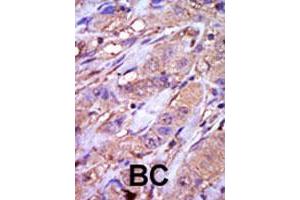 Formalin-fixed and paraffin-embedded human cancer tissue reacted with CSNK1E polyclonal antibody  , which was peroxidase-conjugated to the secondary antibody, followed by DAB staining. (CK1 epsilon Antikörper  (C-Term))