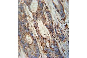 FA antibody (Center) (ABIN654352 and ABIN2844119) immunohistochemistry analysis in formalin fixed and paraffin embedded human colon carcinoma followed by peroxidase conjugation of the secondary antibody and DAB staining. (FAM46A Antikörper  (AA 89-117))