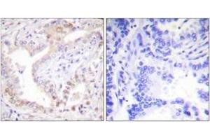 Immunohistochemistry analysis of paraffin-embedded human lung carcinoma tissue, using Lamin A (Cleaved-Asp230) Antibody. (Lamin A/C Antikörper  (Cleaved-Asp230))