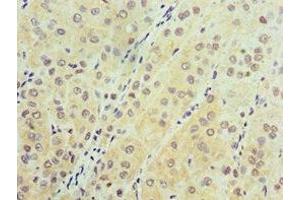 Immunohistochemistry of paraffin-embedded human liver cancer using ABIN7143632 at dilution of 1:100 (AARS2 Antikörper  (AA 841-985))