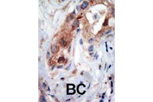 Formalin-fixed and paraffin-embedded human cancer tissue reacted with PIP5K1B polyclonal antibody  , which was peroxidase-conjugated to the secondary antibody, followed by AEC staining. (PIP5K1B Antikörper  (N-Term))