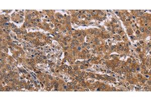 Immunohistochemistry of paraffin-embedded Human liver cancer tissue using FAAH2 Polyclonal Antibody at dilution 1:30 (FAAH2 Antikörper)