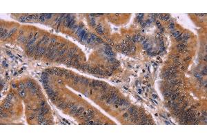 Immunohistochemistry of paraffin-embedded Human colon cancer tissue using CDC5L Polyclonal Antibody at dilution 1:40 (CDC5L Antikörper)