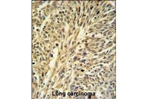 IDH2 Antibody (Center) (ABIN391584 and ABIN2841516) IHC analysis in formalin fixed and paraffin embedded human Lung carcinoma followed by peroxidase conjugation of the secondary antibody and DAB staining. (IMPDH2 Antikörper  (AA 180-210))