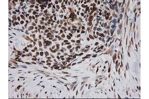 Immunohistochemical staining of paraffin-embedded Adenocarcinoma of Human breast tissue using anti-ERCC4 mouse monoclonal antibody. (ERCC4 Antikörper)