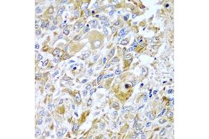 Immunohistochemistry of paraffin-embedded human lung cancer using HAVCR2 antibody at dilution of 1:100 (x40 lens). (TIM3 Antikörper)